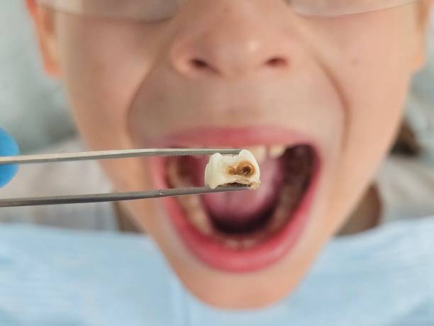 Best Urgent Tooth Repair  in Vidalia, LA